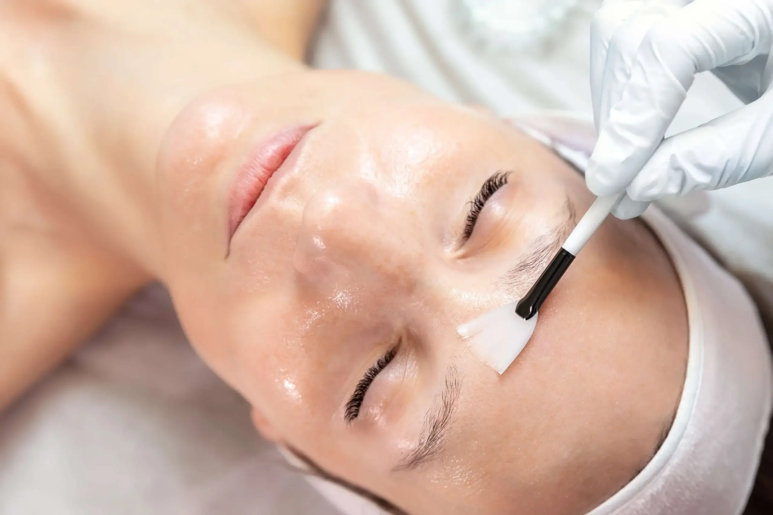 Chemical Peels in Chandler AZ by Opulent Aura Aesthetics LLC