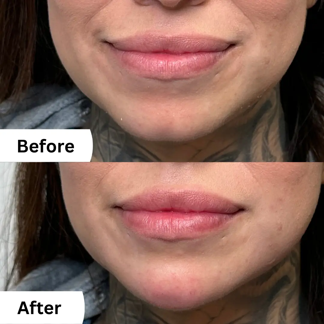 Chin Filler 2